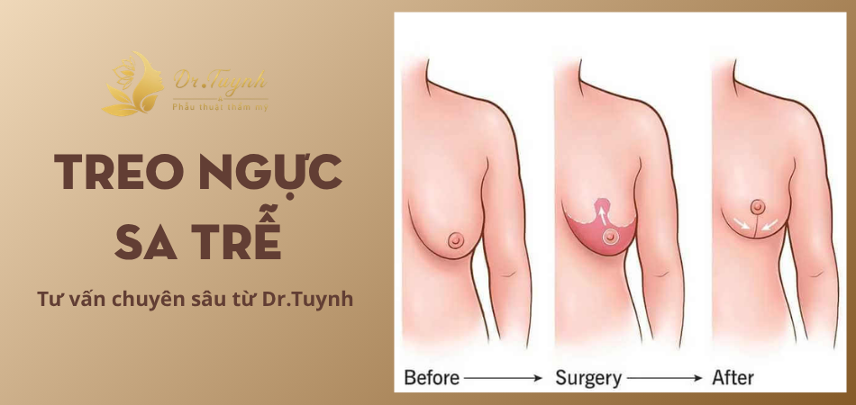 Breast surgery before and after illustration.
